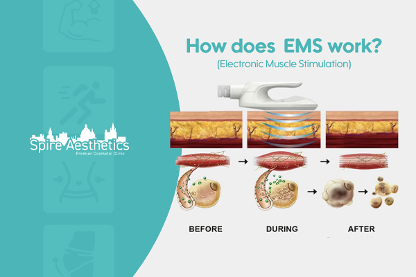 EMS treatment for post pregnancy weight loss treatment South Shields