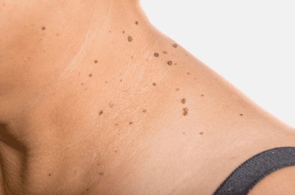 Are you looking for easy skin tag removal South Shields - then contact Spire today!