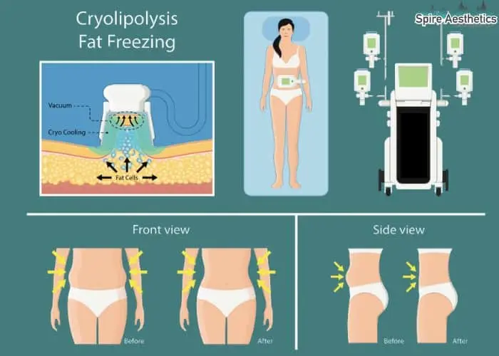 Fat freezing treatment South Shields benefits for competitions to remove stubborn fat deposits.