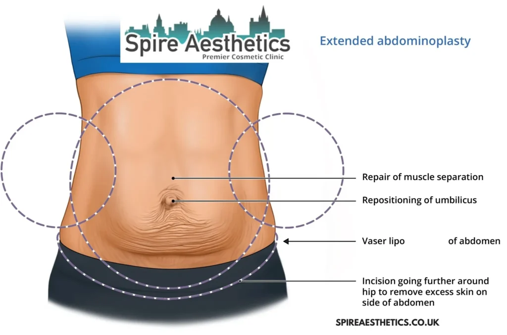 Understanding Loose Skin After Gastric Band South Shields Surgery and HIFU Treatment