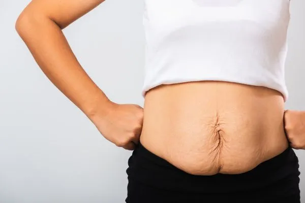 Image of a woman's stomach after weight loss with sagging skin following a gastric band South Shields